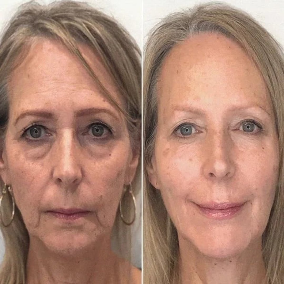 SkinLift™ Sérum Facial Botox